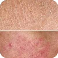 Dry, irritated skin close-up